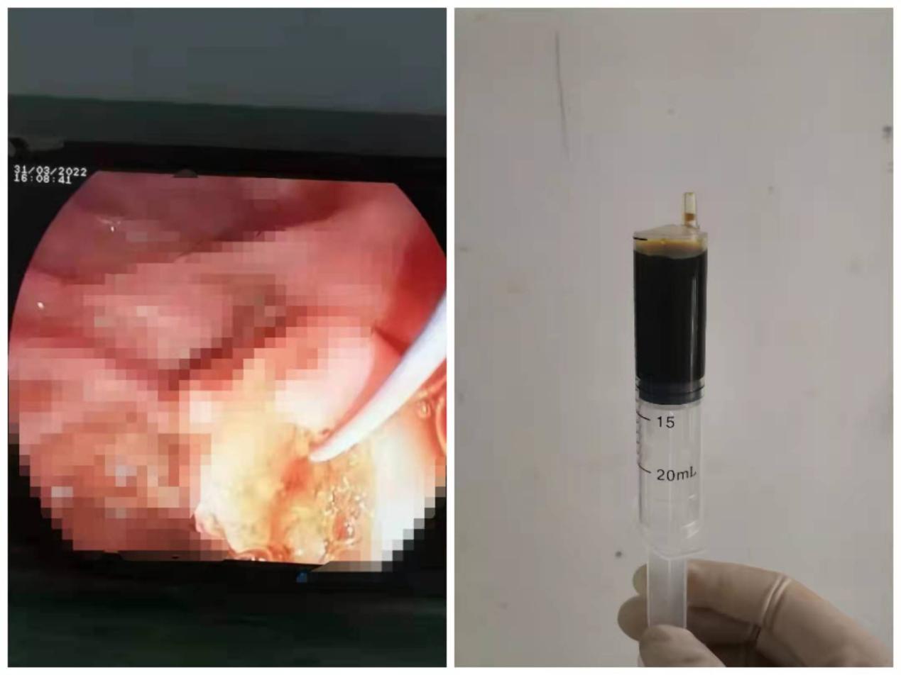 勇于“胆”当，化险为夷！南昌大学二附院消化内科成功救治一位来自中高风险区的急性胆管炎患者