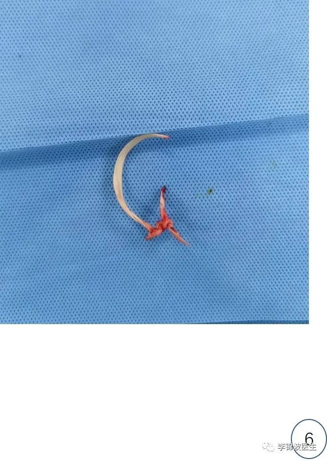 宫颈环扎术的详细步骤,宫颈环扎线拆除多少钱