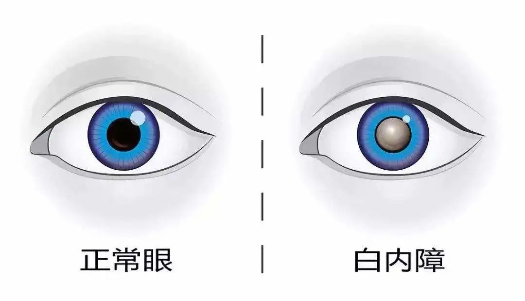 白内障久拖不治成弱视,白内障一直不做手术有什么后果