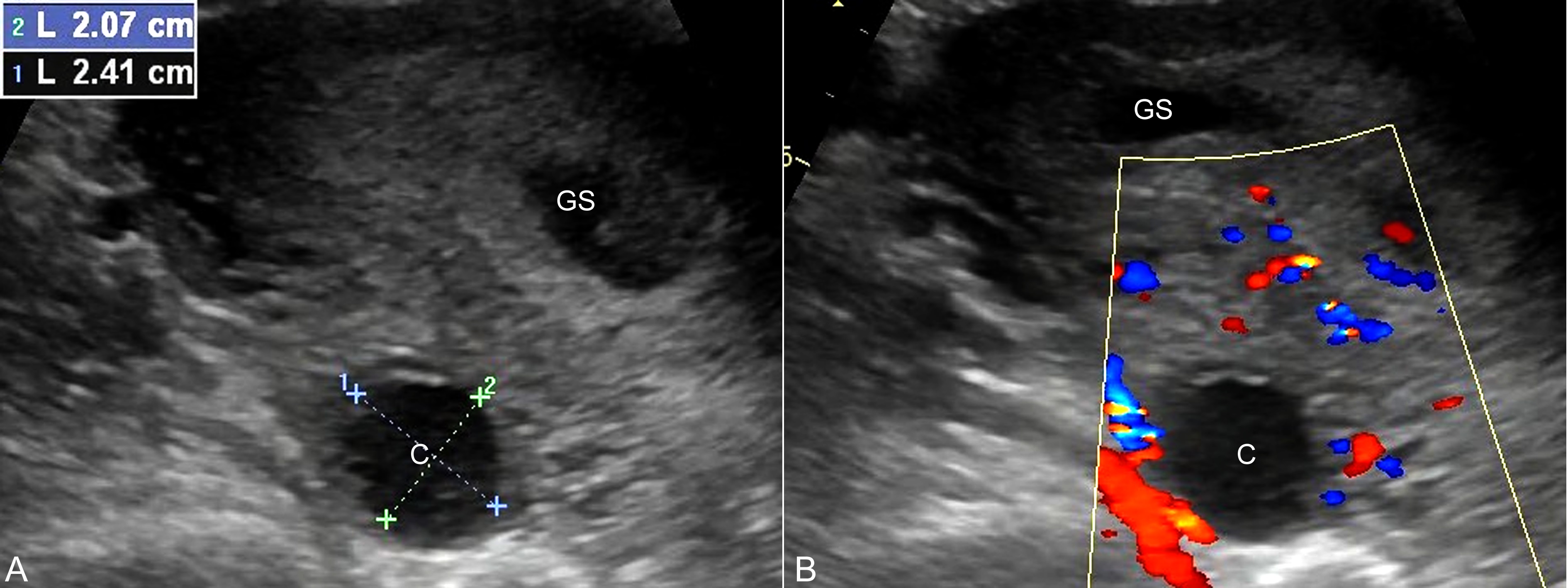 卵巢结节怀孕后变成黄体囊肿,怀孕初期超声有黄体囊肿血流信号