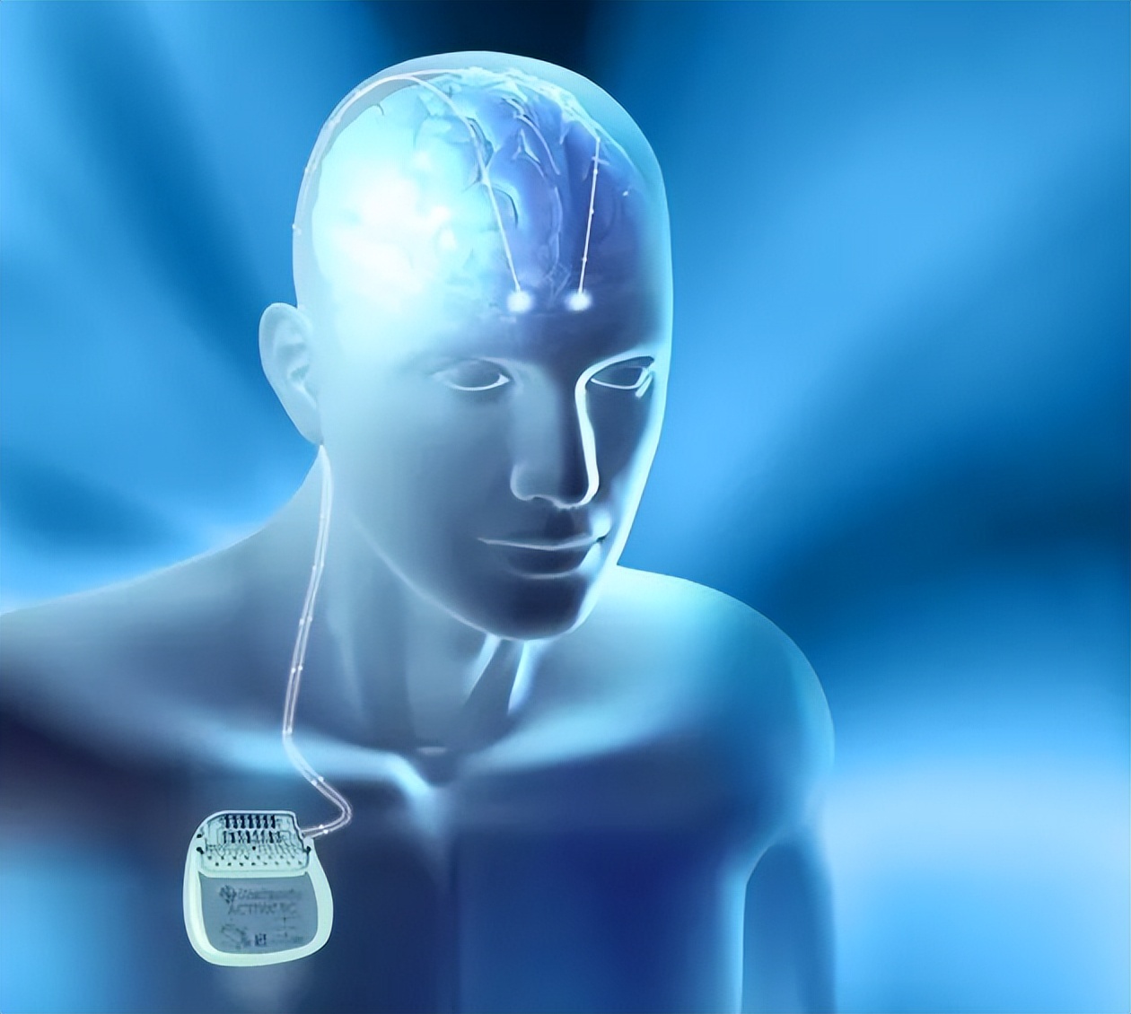 美敦力35,美敦力5.5