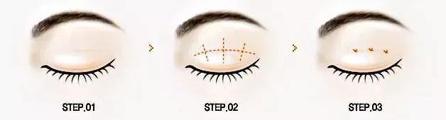 想割双眼皮怕失败,割双眼皮踩雷了应该找医院吗