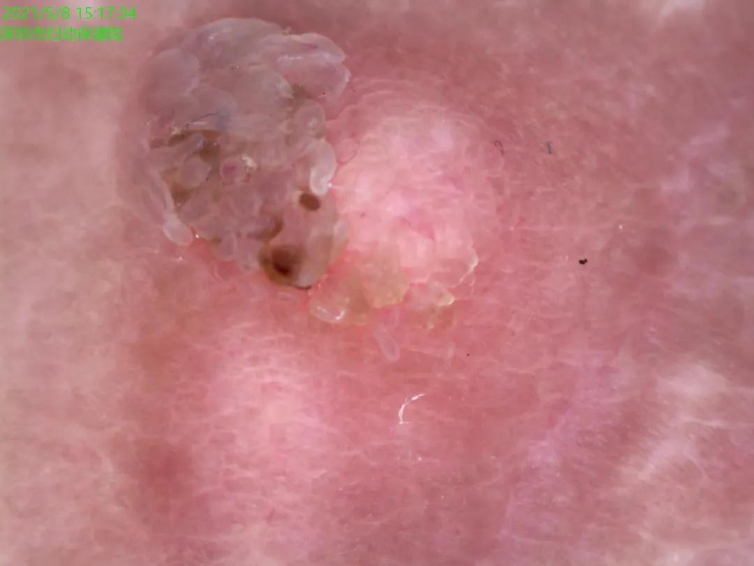 怀孕后脖子上长丝状疣以后会掉吗,怀孕脖子上长了好多小疹子