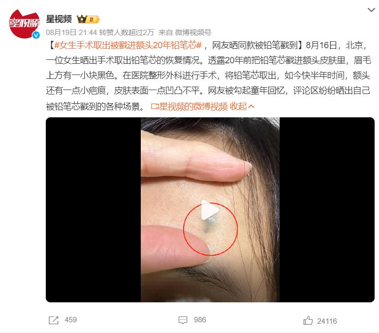 小孩把铅笔芯不小心捅进手皮里了,8岁孩子被铅笔戳到手怎么办