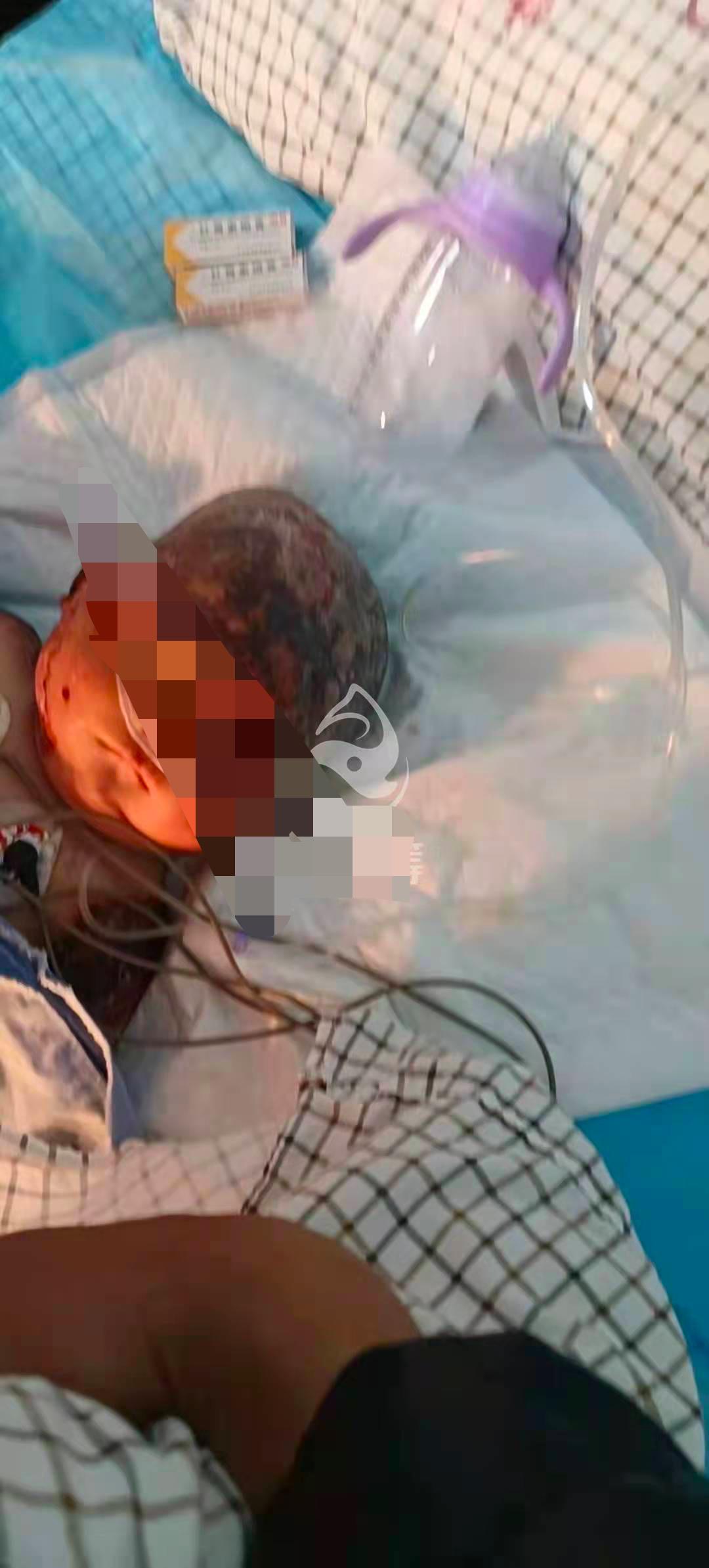 云南一女子癫痫发作怀中婴儿跌入火炉治疗费预估40万53岁丈夫携捐款失联