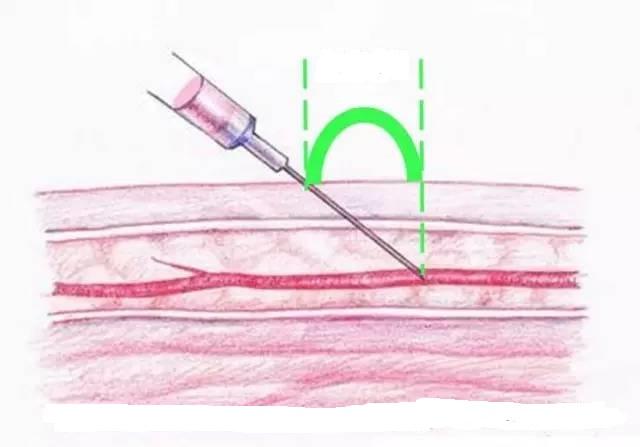 一抽血胳膊就变青是怎么回事,抽血后青了一块是什么原因