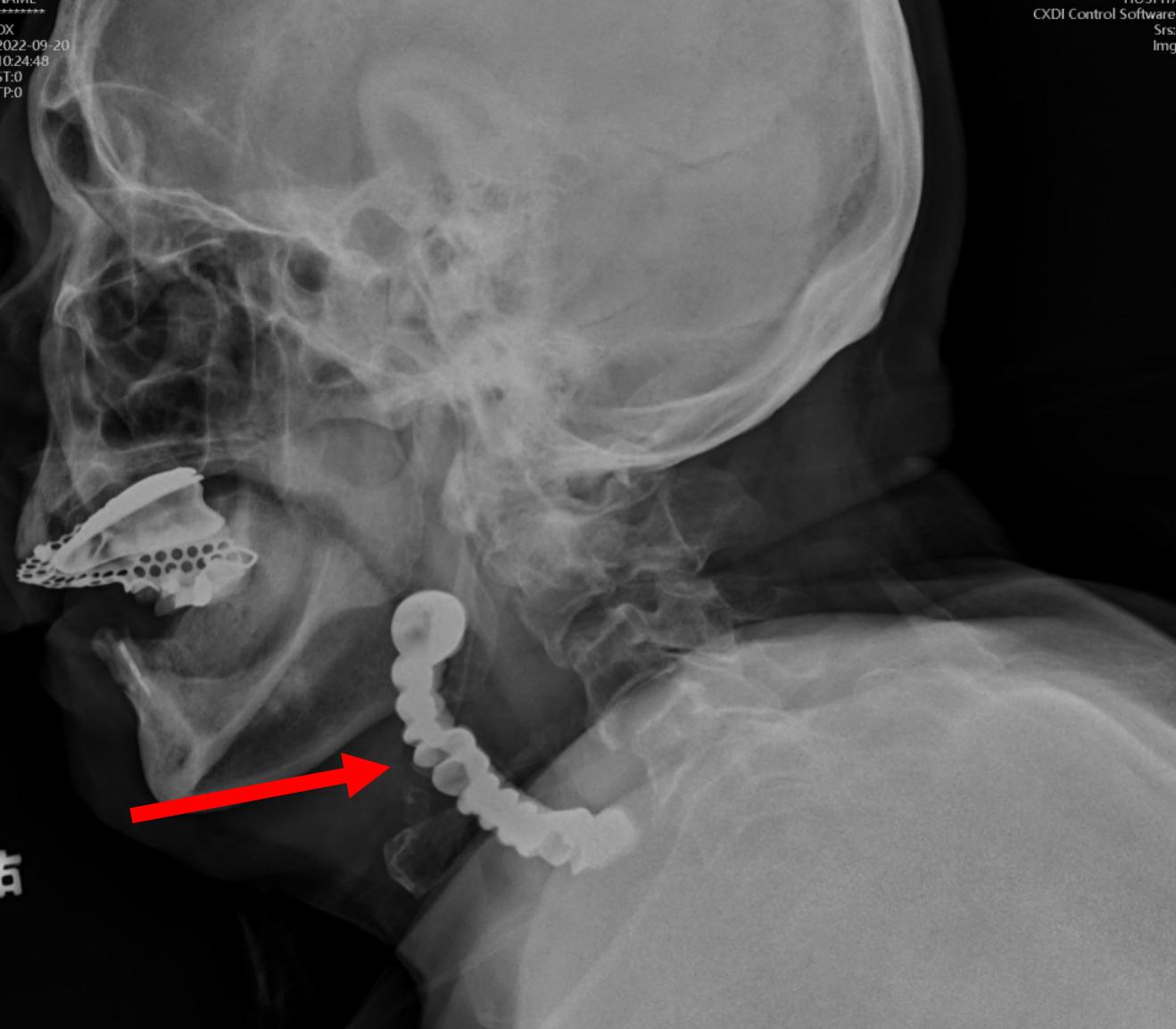 74岁老人误吞带钩假牙,老人误吞假牙怎么取出