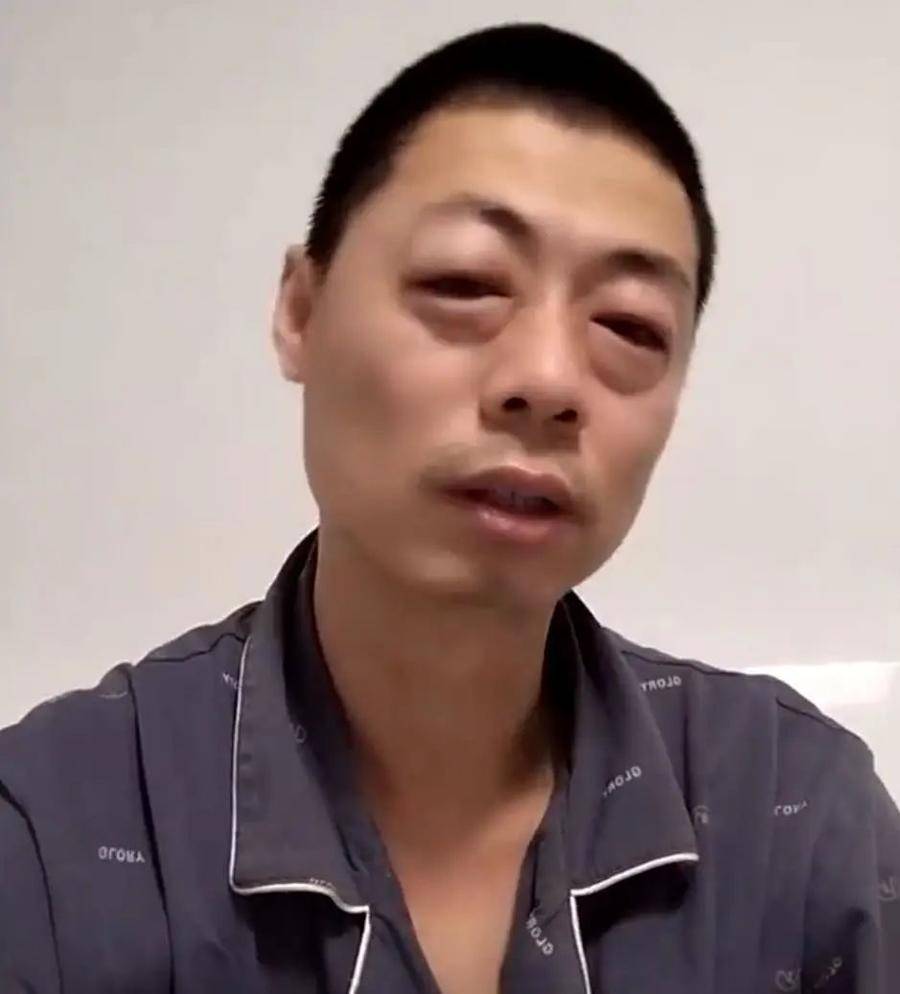 感染后头发变直了,感染后一夜白发