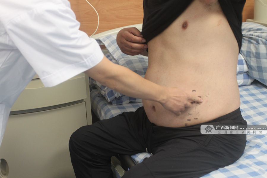 胰岛素移植治疗糖尿病最新进展,再生胰岛移植治疗1型糖尿病