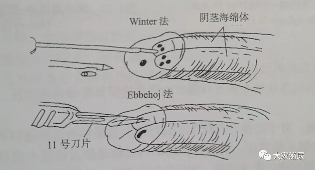 干货│缺血型阴茎异常勃起的治疗