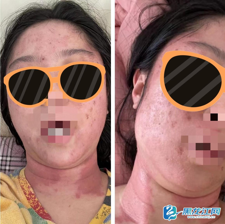 做了美容眼睛肿了过敏瘙痒,做美容被毁容的女孩