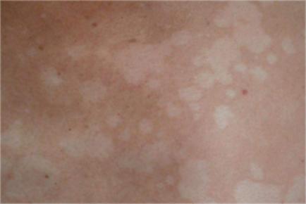 天气寒冷谨防三种皮肤病,雨季是皮肤病高发季节吗