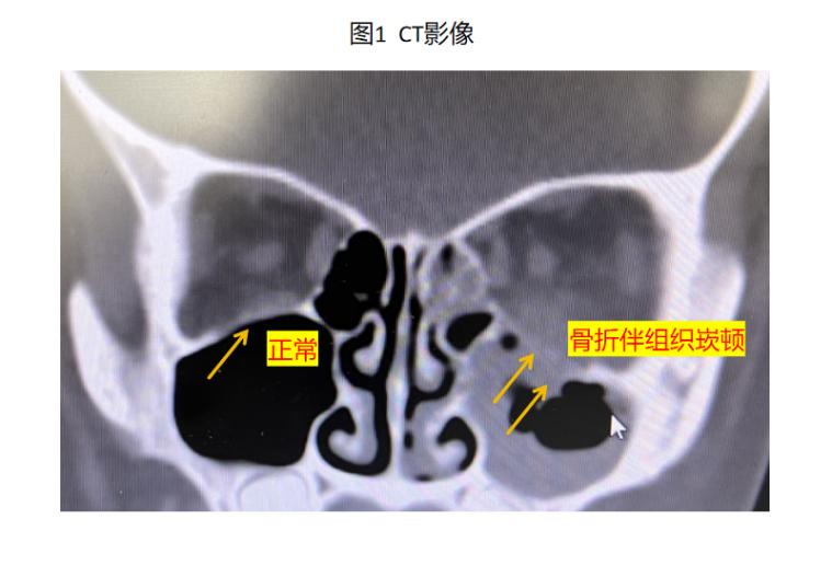 小儿眼睛被撞,小孩眼睛被同学撞肿了怎么办