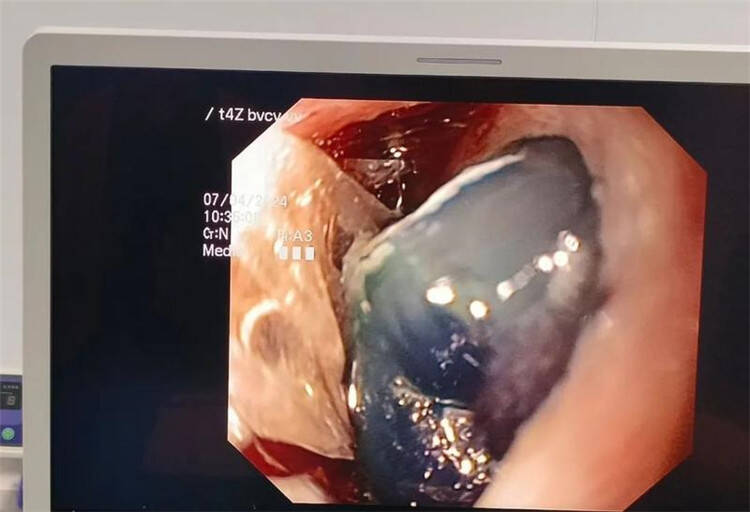 宝宝啃玩具啃恶心吐了,婴儿吃了塑料玩具一周后呕吐